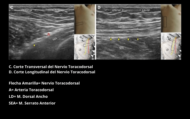 Nervio Toracodorsal (1).png